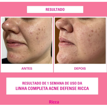 Segunda imagem do produto Ricca - Acne Defense - Gel Secativo de Acne 15g